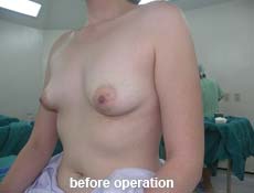 plastic-surgery-breast-augmentation 